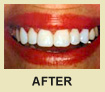 After cosmetic dental treatment